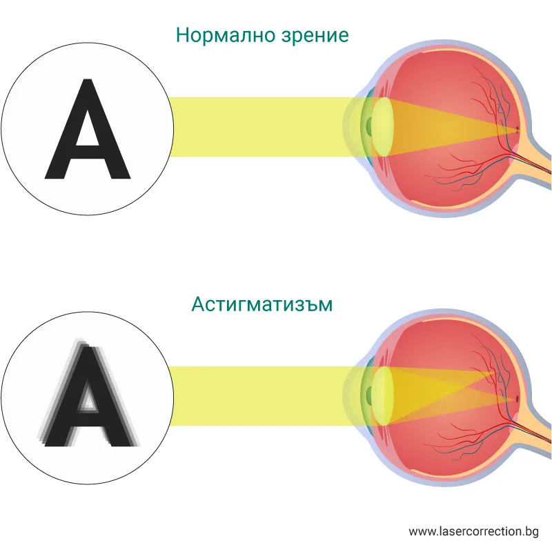 Астигматизъм