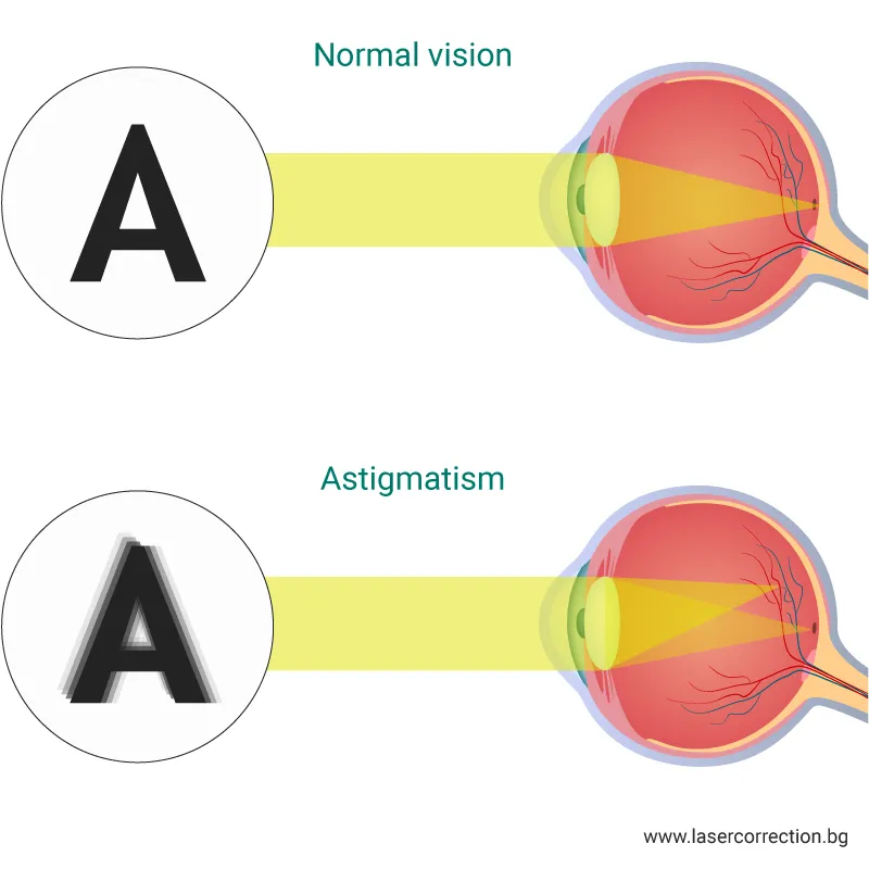 Astigmatism