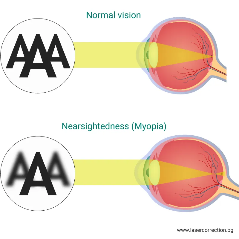 Nearsightedness